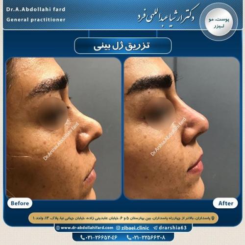 تزریق ژل در تهران 72