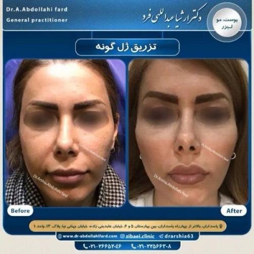 تزریق ژل در تهران 73