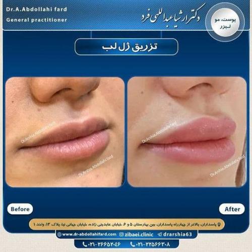 تزریق ژل در تهران 74