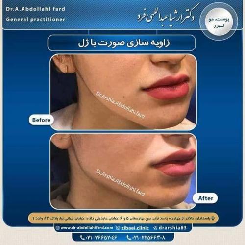 تزریق ژل در تهران 75