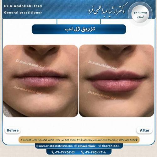تزریق ژل لب 1