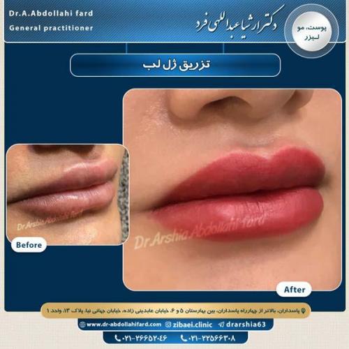 تزریق ژل لب 3