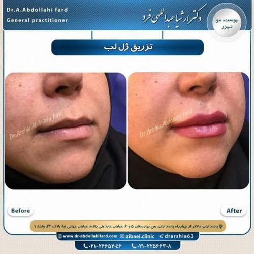 تزریق ژل لب 6