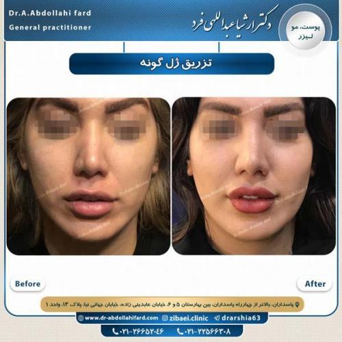 تزریق ژل گونه