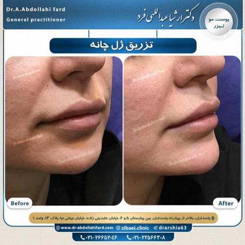 تزریق ژل گونه 1