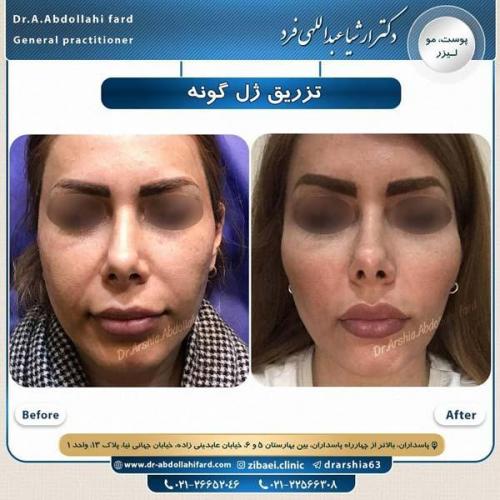 تزریق ژل گونه 4