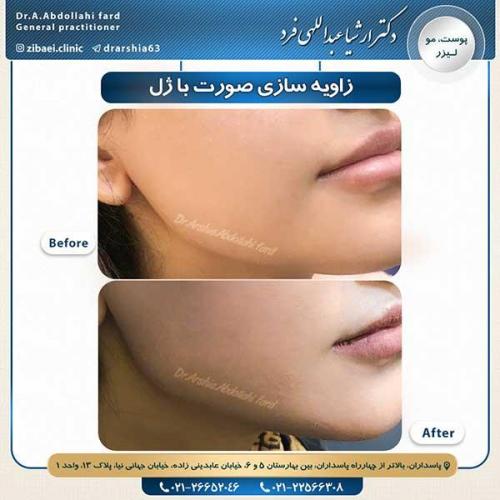 زاویه-سازی-صورت-با-ژل-1