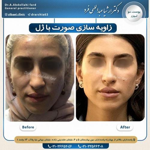 زاویه سازی صورت 1