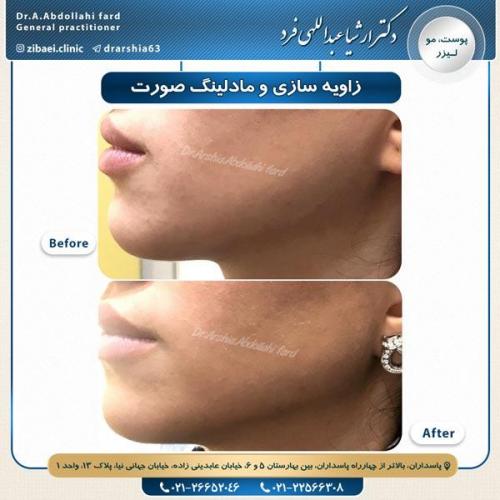 زاویه سازی صورت 2
