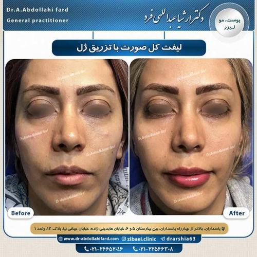 لیفت-صورت-با-تزریق-ژل-1