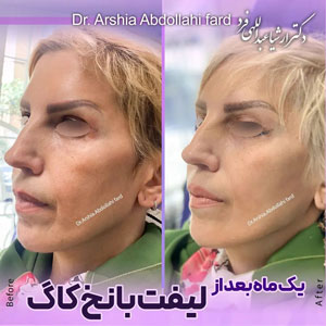 لیفت-صورت-10