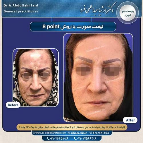 لیفت صورت 1